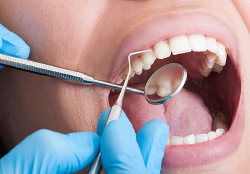 Lấy cao răng có giải quyết được tình trạng hôi miệng không?