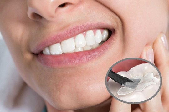 Nguyên nhân và cách xử lý tình trạng nhức răng sau khi trám