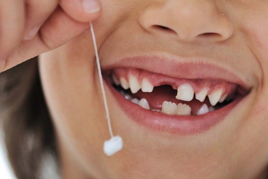 Những sai lầm thường gặp khi nhổ răng sữa cho trẻ